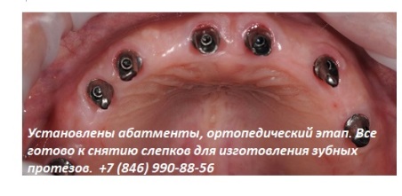 Имплантаты действуют как естественный корень зуба, который передает жевательную силу и поддерживает здоровье костей. После того, как вы обсудили все возможные варианты лечения со своим имплантологом и выбрали именно этот метод восстановления, затем спланируйте и разместите имплантаты. Взято с сайта http://denterum.ru/prizhivaemost-implantov